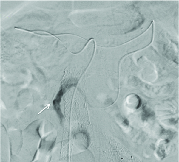 Embolization of a Type II Endoleak With Interlock™18 Coils
